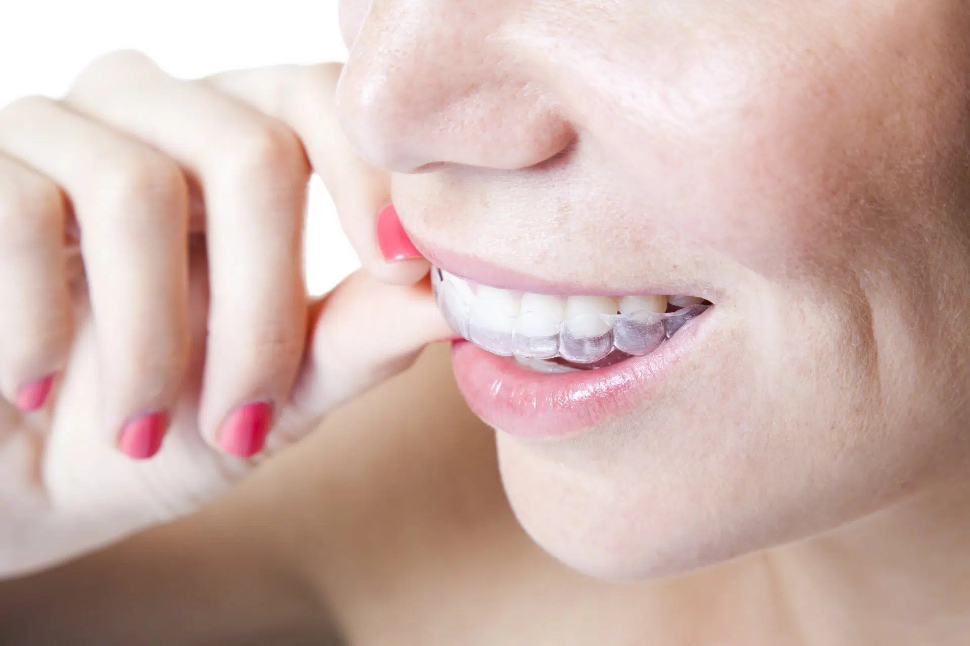 Achieve the perfect smile with our comfortable and clear Invisalign treatment.