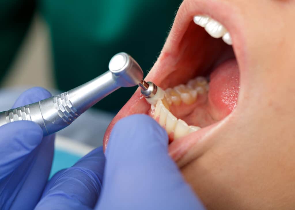 A dentist performing a dental cleaning