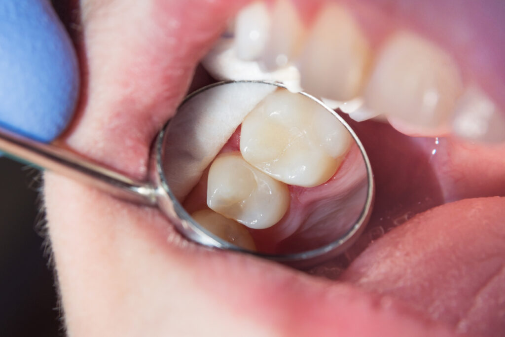 Dental patient with a filling that cannot be seen